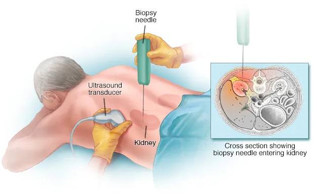 बायोप्सी टेस्ट की प्रक्रिया Process Of Biopsy